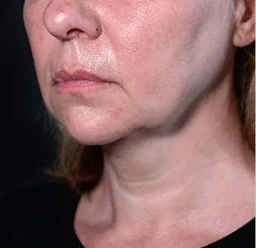 Înainte de tratament - profil